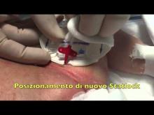 Embedded thumbnail for GAVeCeLT - Medicazione accesso venoso femorale in neonato