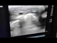 Embedded thumbnail for RaCeVA in neonato